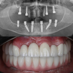 Bone level dental implants and full arch dental prosthesis in dentistry. Full mouth implant supported prosthesis for edentulous jaws. Dental before after and smile makeover.   © UniqDream
