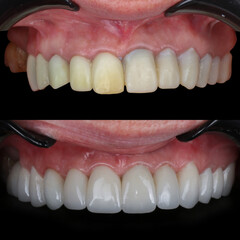 Full mouth porcelain crown treatment in cosmetic dentistry. Correction of crooked and deformed...