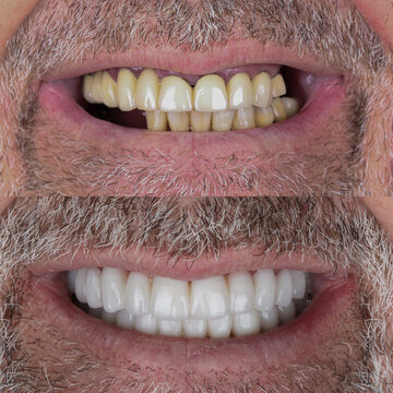 Full mouth porcelain crown treatment in cosmetic dentistry. Correction of crooked and deformed teeth with porcelain veneers. Dental before after and smile makeover.

