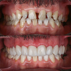 Dental treatment in dentistry. Smile design treatment with dental design. New tooth design with porcelain crowns. Full arch dental treatment. Dental before after and smile makeover.

