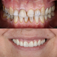 Treatment of all teeth in the mouth with porcelain crowns in dentistry. Smile design treatment. Smile makeover with digital dentistry. Dental before after. © UniqDream
