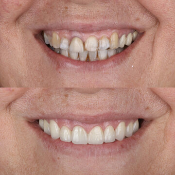 Treatment of front incisors with dental implants through oral surgery. Implant treatment of anterior aesthetic zone with E-Max and zirconia porcelain. Dental before after.

