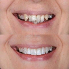 Dental treatment in dentistry. Smile design treatment with dental design. New tooth design with...