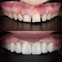 Treatment of all teeth in the mouth with porcelain crowns in dentistry. Smile design treatment. Smile makeover with digital dentistry. Dental before after. © UniqDream