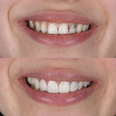 Dental design treatment in aesthetic dentistry. Full mouth smile makeover with glass ceramic porcelains. Dental veneers and bridge treatment. Dental before after and smile makeover.   © UniqDream
