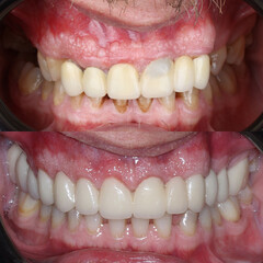 Dental design treatment in aesthetic dentistry. Full mouth smile makeover with glass ceramic porcelains. Dental veneers and bridge treatment. Dental before after and smile makeover.   © UniqDream