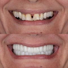 Treatment of all teeth in the mouth with porcelain crowns in dentistry. Smile design treatment. Smile makeover with digital dentistry. Dental before after. © UniqDream