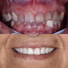 Dental design treatment in aesthetic dentistry. Full mouth smile makeover with glass ceramic porcelains. Dental veneers and bridge treatment. Dental before after and smile makeover.   © UniqDream