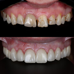 Treatment of all teeth in the mouth with porcelain crowns in dentistry. Smile design treatment. Smile makeover with digital dentistry. Dental before after. © UniqDream