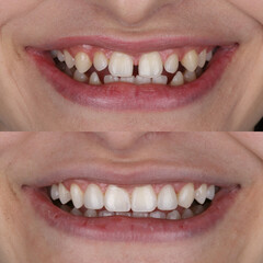 Treatment of deformed and discolored teeth with composite filling in dental care. Filling treatment...
