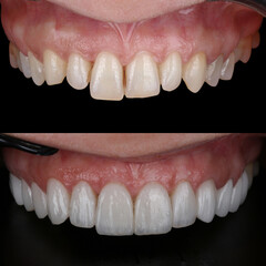 Dental design treatment in aesthetic dentistry. Full mouth smile makeover with glass ceramic porcelains. Dental veneers and bridge treatment. Dental before after and smile makeover.   © UniqDream