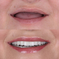 Bone level dental implants and full arch dental prosthesis in dentistry. Full mouth implant supported prosthesis for edentulous jaws. Dental before after and smile makeover.   © UniqDream