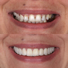 Treatment of all teeth in the mouth with porcelain crowns in dentistry. Smile design treatment. Smile makeover with digital dentistry. Dental before after. © UniqDream