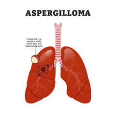 Aspergilloma Lung or mycetoma disease, educational medical poster design healthcare scheme, human lung disease internal organs. Labeled fungus ball, mold clump in body cavity.