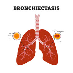 Bronchiectasis Lungs or Cystic Fibrosis, educational medical poster design healthcare scheme, human lung disease internal organs. Labeled damaged wall airway, increase mucus, loss of cilia.