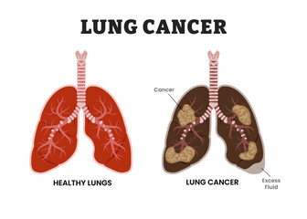 Healthy Lungs vs Lung Cancer or bronchogenic carcinoma,, educational medical poster design healthcare scheme, human lung disease internal organs. Labeled excess fluid, malignant tumor, parenchyma.