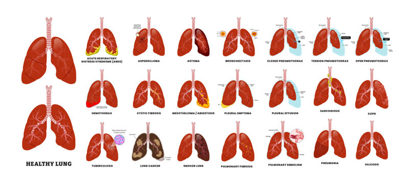 Big Set of Lung Disease set collection, educational medical poster design healthcare scheme, human lung disease internal organs. Labeled Pulmonary Fibrosis, Aspergilloma,Hemothorax, COPD, Pneumothorax