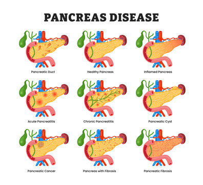 Set of Pancreas Disease Set Collection, educational medical poster design healthcare scheme, human pancreas disease internal organs. Labeled Acute, Chronic, Healthy, Inflamed, Fibrosis, Cancer, Cyst.