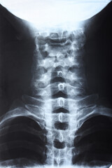 X-ray image of human neck, closeup