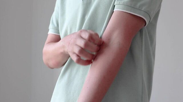 Young asian man itching and scratching on arm from allergic itchy dry skin eczema dermatitis insect bites