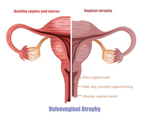 Vulvovaginal Atrophy