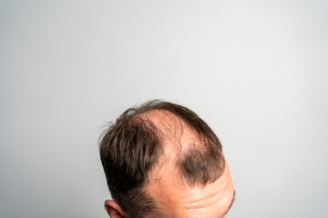 Obraz premium Close-up balding head of a young man on a on gray isolated background.