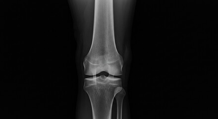 Knee joint illuminated on Xray film