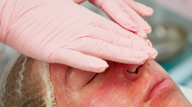 Red girl skin receiving gentle treatment at cosmetology clinic. Professional gloved hands soothing sensitive facial skin with careful touch. Specialist focusing on calming irritation and improving