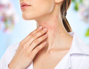 heat rash