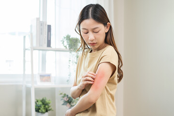 Dermatology asian young woman, girl allergy, allergic reaction from atopic, insect bites on her arm, hand in scratching itchy, itch red spot or rash of skin. Healthcare, treatment of beauty.