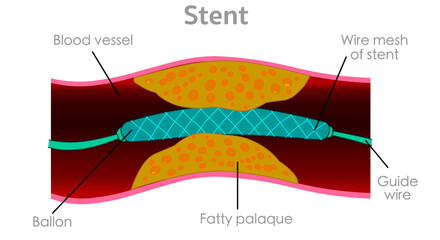  Coronary artery stent, angioplasty .Blocked blood vessels, fatty steak plaque,  cardiac bypass ,wire balloon. Vector illustration