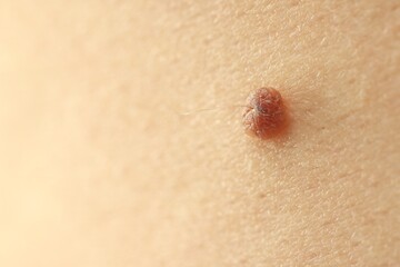 Man with mole on his skin, closeup. Space for text