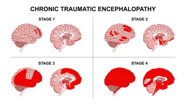 Chronic Traumatic Encephalopathy Brain Illustration