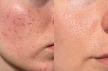 Two-panel close-up showing dramatic facial skin transformation after acne treatment. Clearer, smoother, and healthier texture is visible.