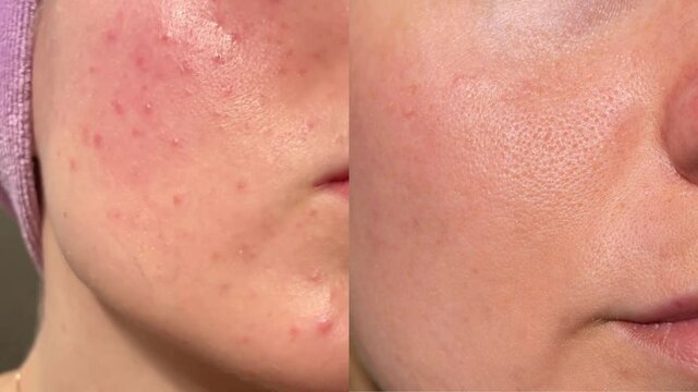 Close-up acne skin before and after cosmetic treatment. Redness, blemishes, and inflammation visibly reduced. Clearer texture achieved naturally.