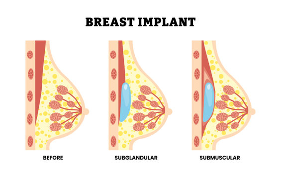 Different types of breast implant types with side view, educational medical poster design healthcare scheme, labeled healthy breast, subglandular, submuscular. Modify the size and shape of breasts.