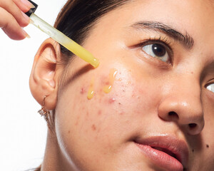 South East Asian Indonesian Women Apply Skincare Treatment for Natural Pimple Face Condition in Home Setting