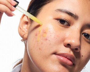 South East Asian Indonesian Women Demonstrate Skincare Routine With Pimple Face Condition and Treatment Application