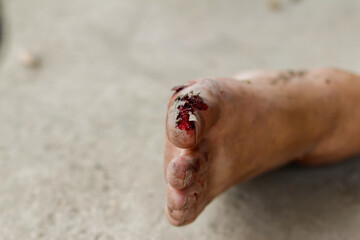 Focus is soft and blurry.The toe of the injured man, with a traumatic tear and bleeding, prevented the victim from standing up because of a foot injury and was waiting for emergency medical help.