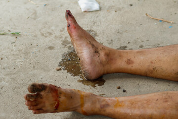 Focus is soft and blurry.The toe of the injured man, with a traumatic tear and bleeding, prevented the victim from standing up because of a foot injury and was waiting for emergency medical help.