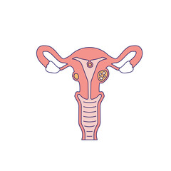 uterine fibroids