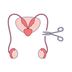 Vasectomy illustratrion