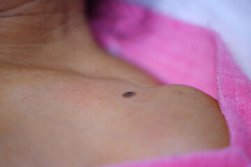 seborrheic keratosis or wart Shoulder and chest area