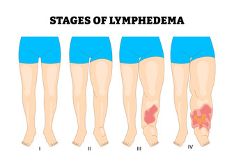 Stages of Lymphedema leg or foot stages process development process, educational medical poster design healthcare scheme, labeled swelling in the legs or feet, blocked lymphatic system fluid.