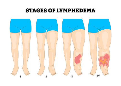 Stages of Lymphedema leg or foot stages process development process, educational medical poster design healthcare scheme, labeled swelling in the legs or feet, blocked lymphatic system fluid.