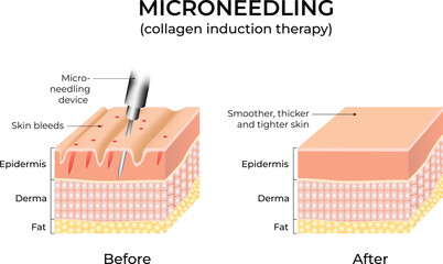 Microneedling procedure illustration showing skin layers before and after treatment. Design Vector Illustration