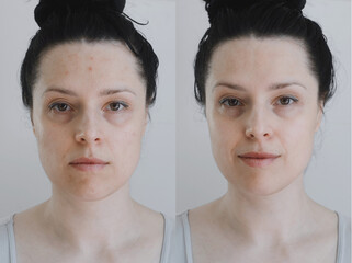 Female face comparison before and after cosmetic procedures