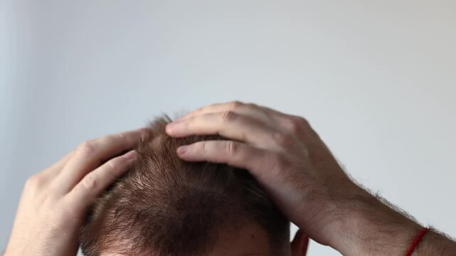 Dandruff control. Hair problems. Male pattern baldness. guy examines his head with his hands from lost hair