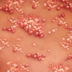 Herpes Virus and Shingles as a contagious skin rash with blisters as cold sores or chicken pox outbreak disease as a medical illustration concept.