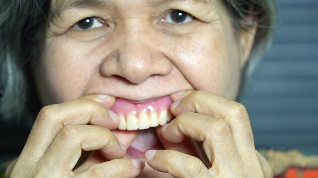 An elderly Asian woman experiments with removing and replacing her dentures to get a better fit.
